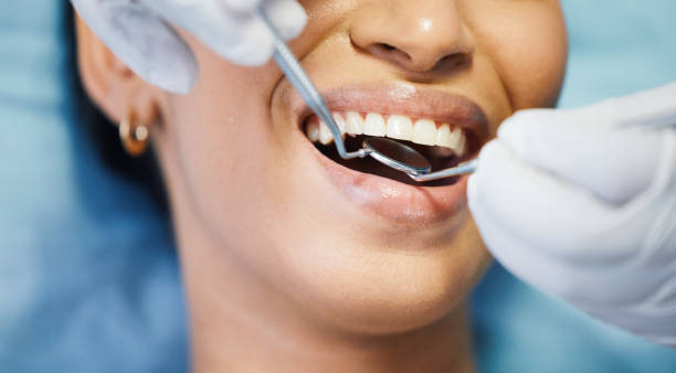 Emergency Dental Filling Replacement in CA