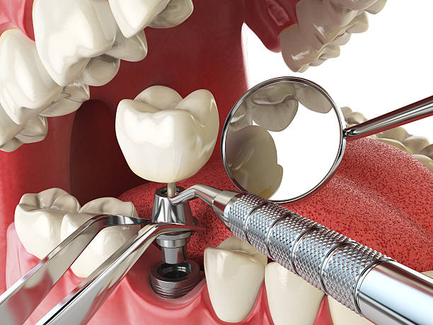 Tooth Infection Emergency Dentist in CA